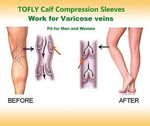 TOFLY Calf Compression Sleeve 20-30mmHg 1 Pair Footless For Men & Women | Footless Compression Socks For Leg Support, Shin Splint, Pain Relief, Swelling, Varicose Veins, Maternity, Nursing, & Travel