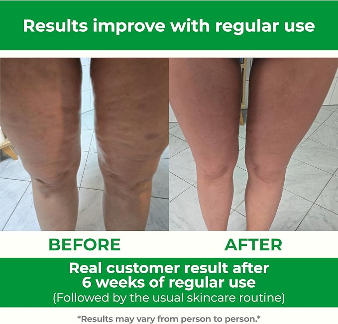 TESMED Cellulite Manual Massager Roller for Thighs and Buttocks | Made in Italy and patented, with converging and diverging roller technology for targeted anti-cellulite massage.